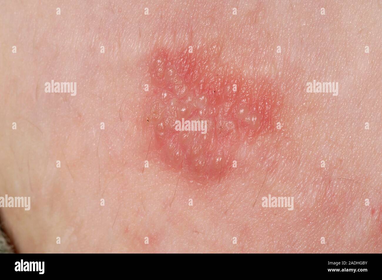 Herpes simplex lesion on the arm of a 44-year-old woman. Herpes simplex is  a common viral infection that leads to painful skin blisters. Anti-viral me  Stock Photo - Alamy