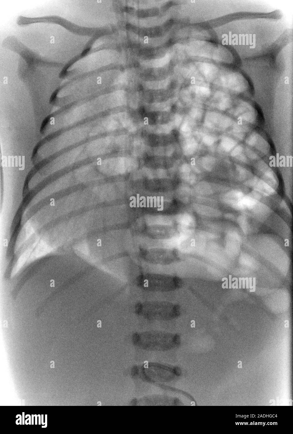 Congenital diaphragmatic hernia. Xray of the chest of a newborn baby