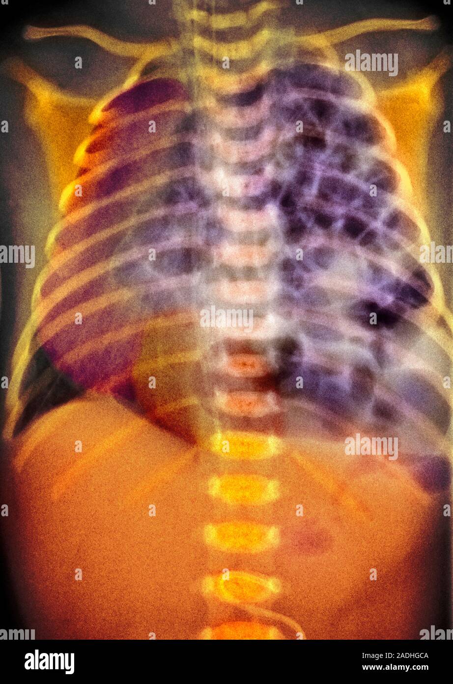 Congenital diaphragmatic hernia. Coloured X-ray of the chest of a ...
