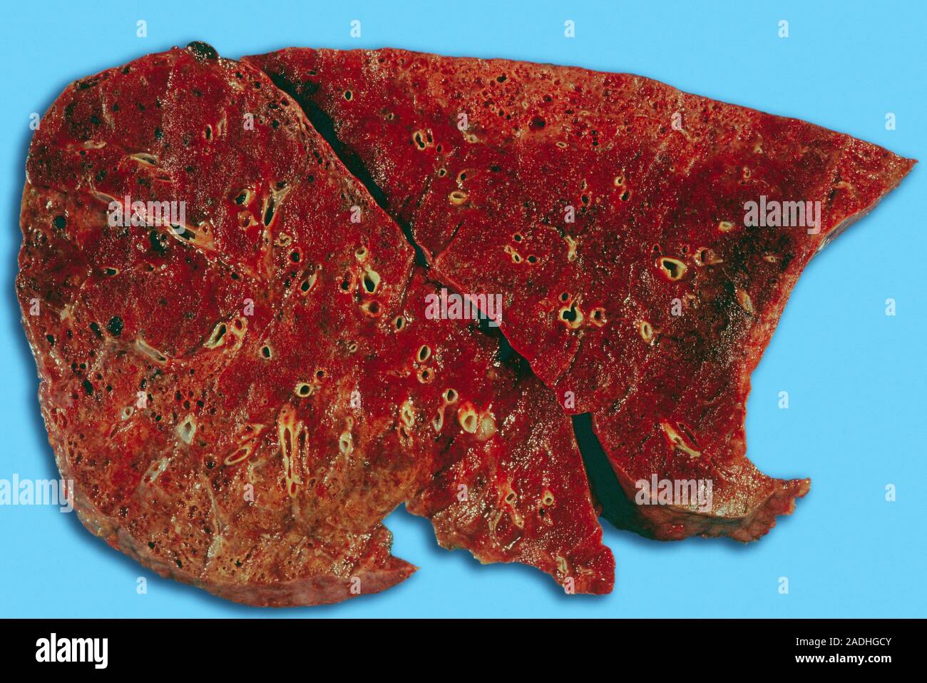 lung, gross specimen. lung is a longterm