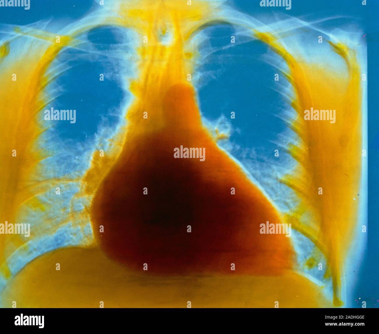 Falsecolour chest Xray in a case of right ventricular hypertrophy