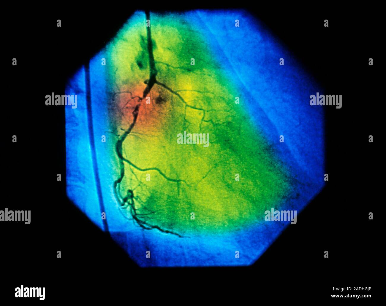 Coronary artery disease: false-colour coronary artery angiogram showing ...