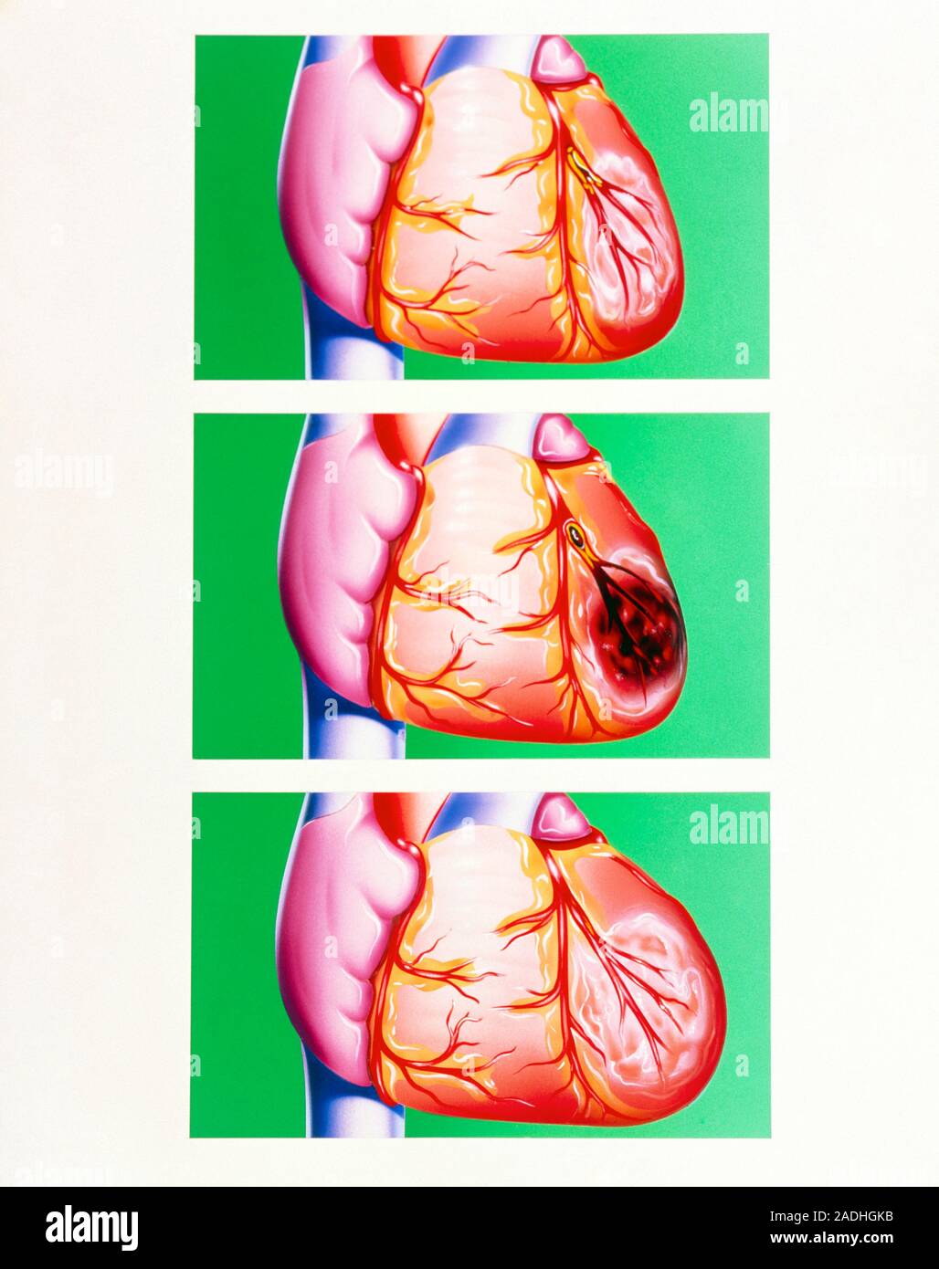 Heart disease. Three illustrations representing diseased conditions of ...
