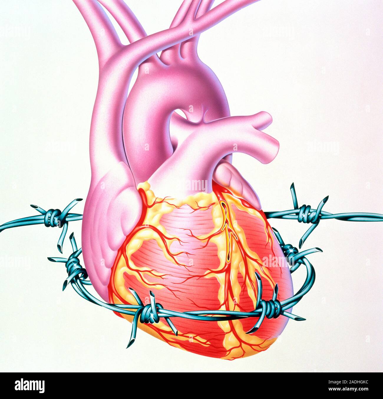 Сердечная сосудистая недостаточность шок. Ишемическая болезнь сердца стенокардия. ИБС сердца и стенокардию. Заболевания коронарных сосудов.
