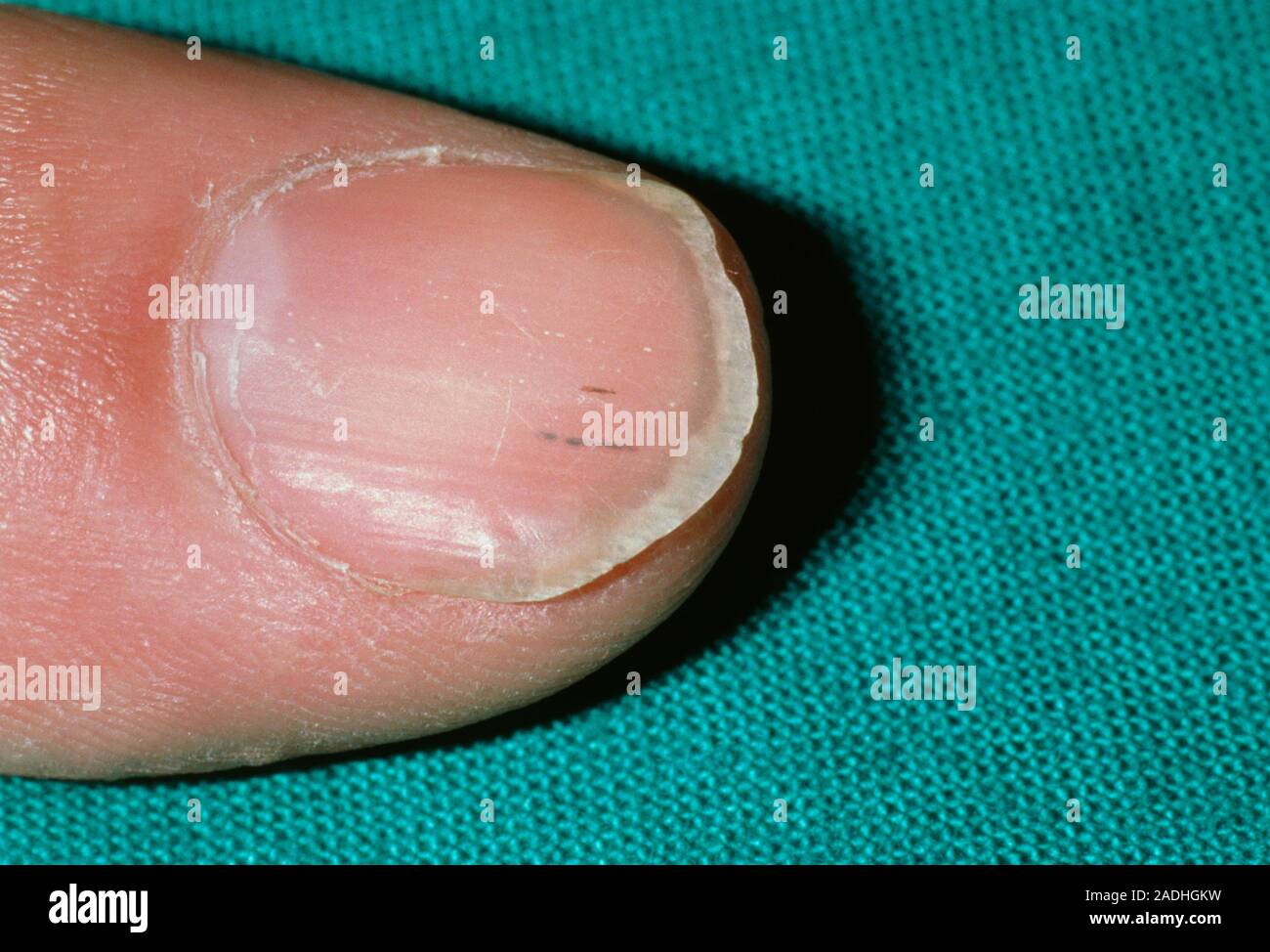 Endocarditis in fingernail. Closeup of a finger nail showing splinter