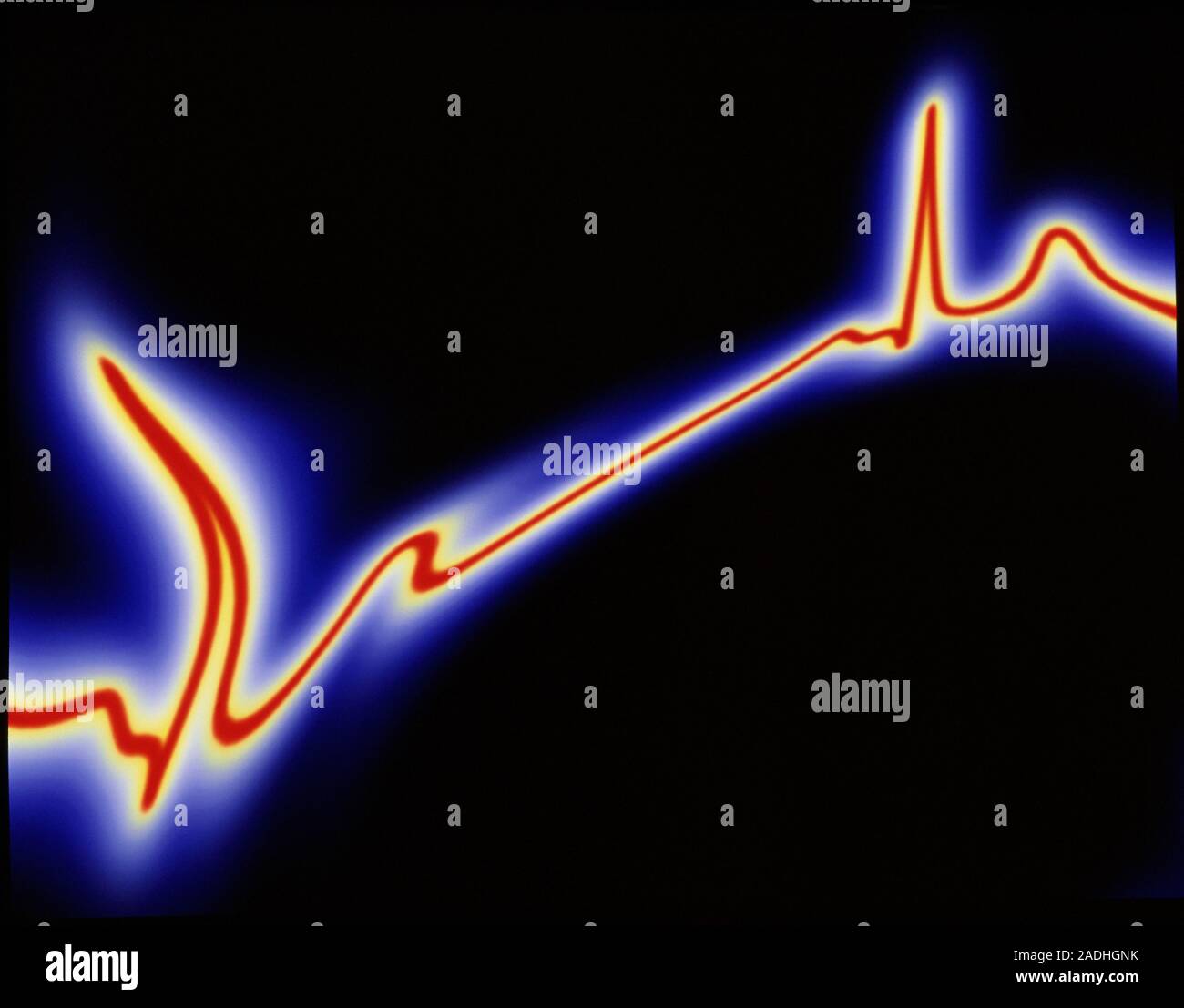 Irregular heartbeat. Computerenhanced image of an electrocardiograph