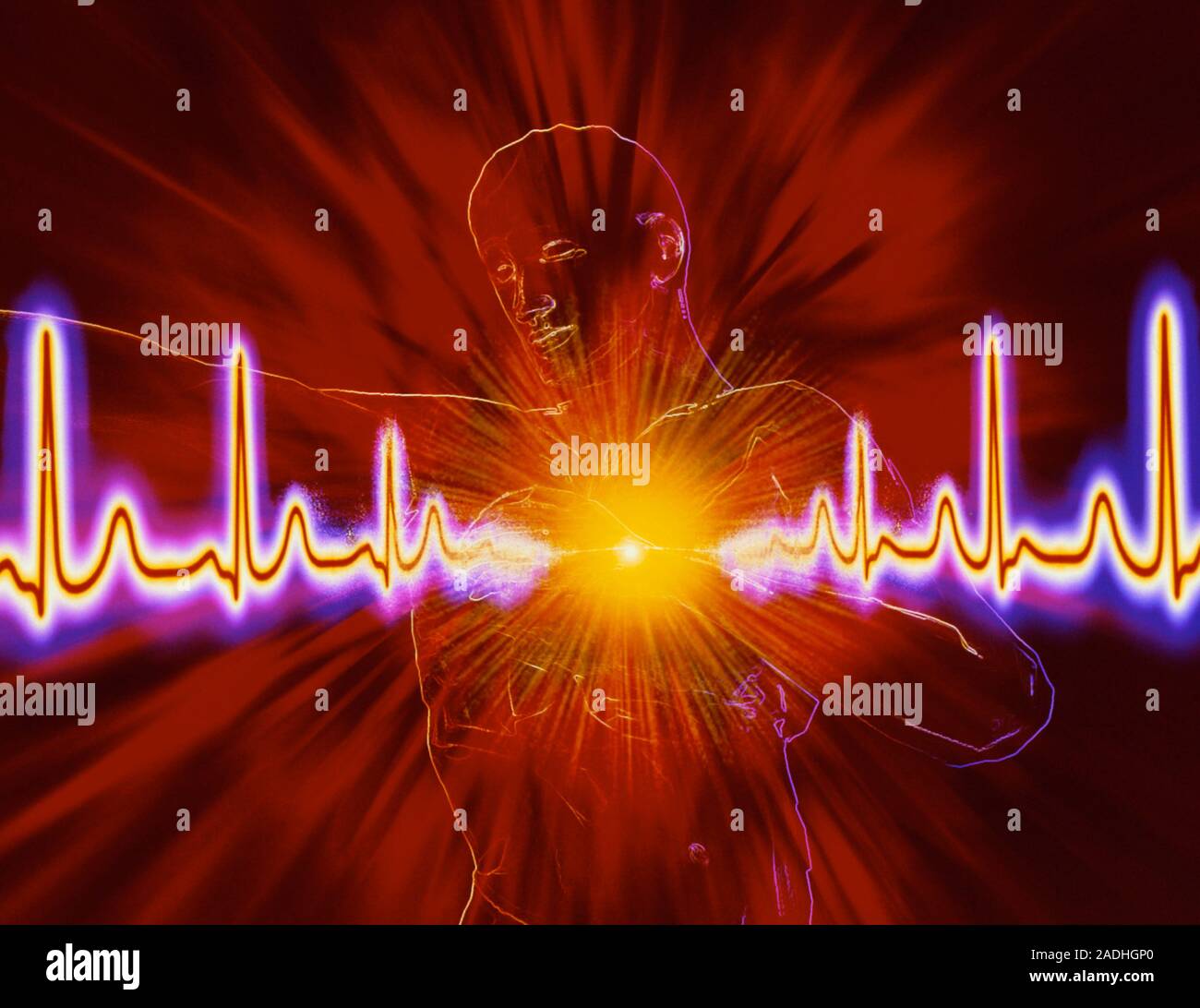 Heart attack. Computer artwork of the outline of a male figure with his ...
