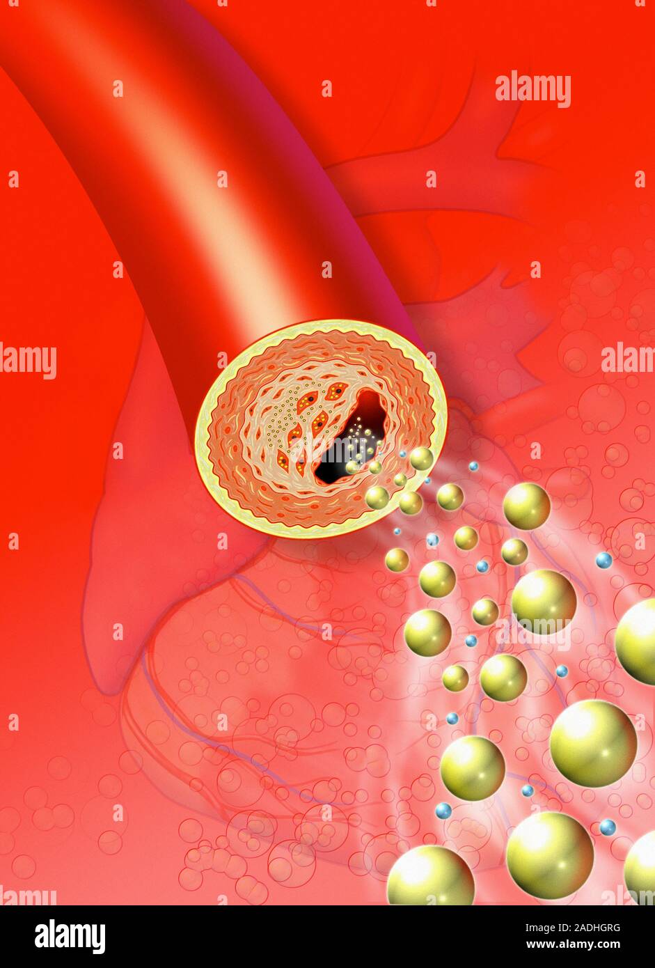 Narrowed coronary artery. Artwork of a coronary artery that has been