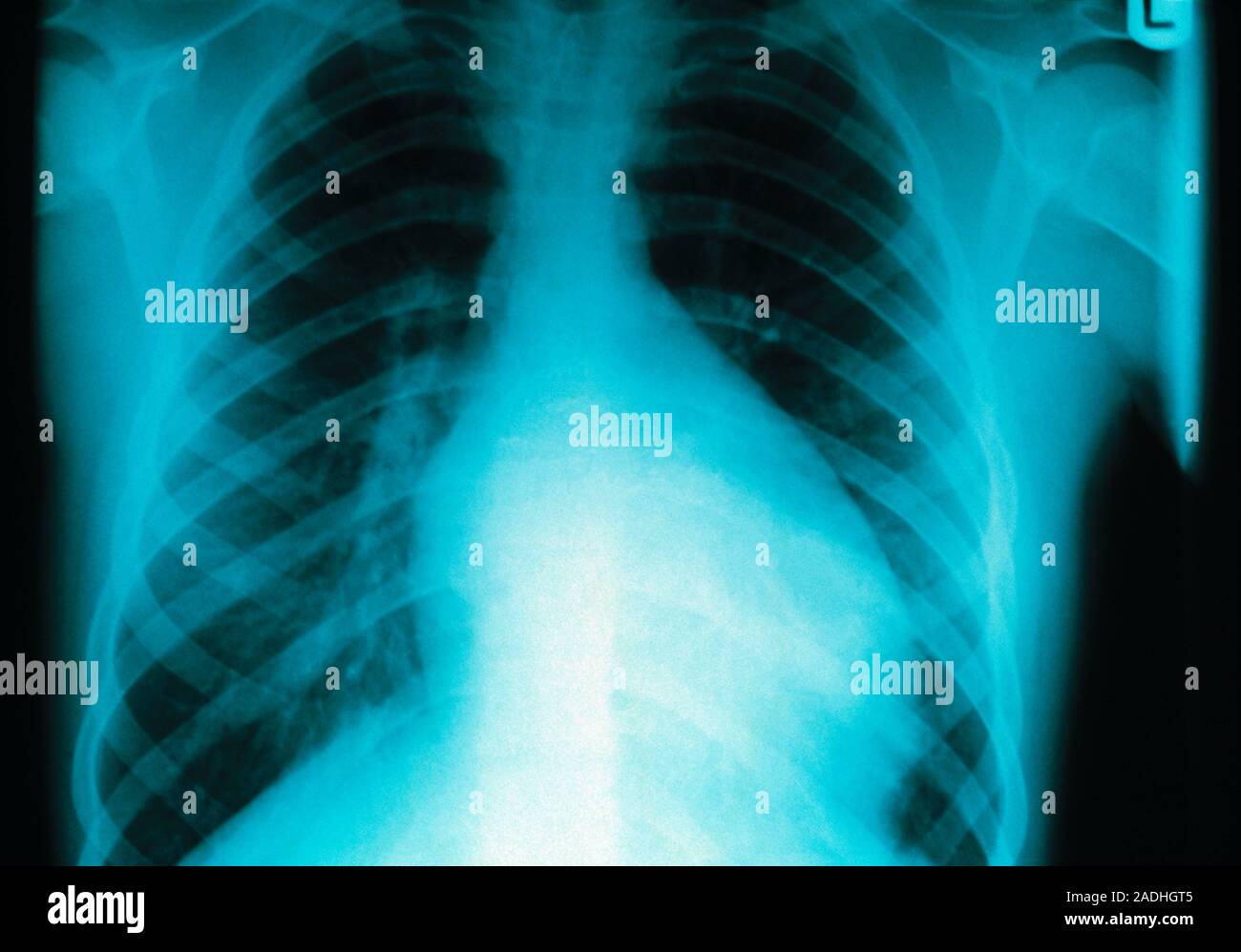 Enlarged heart. Chest Xray of the enlarged heart (cardiomegaly, blue