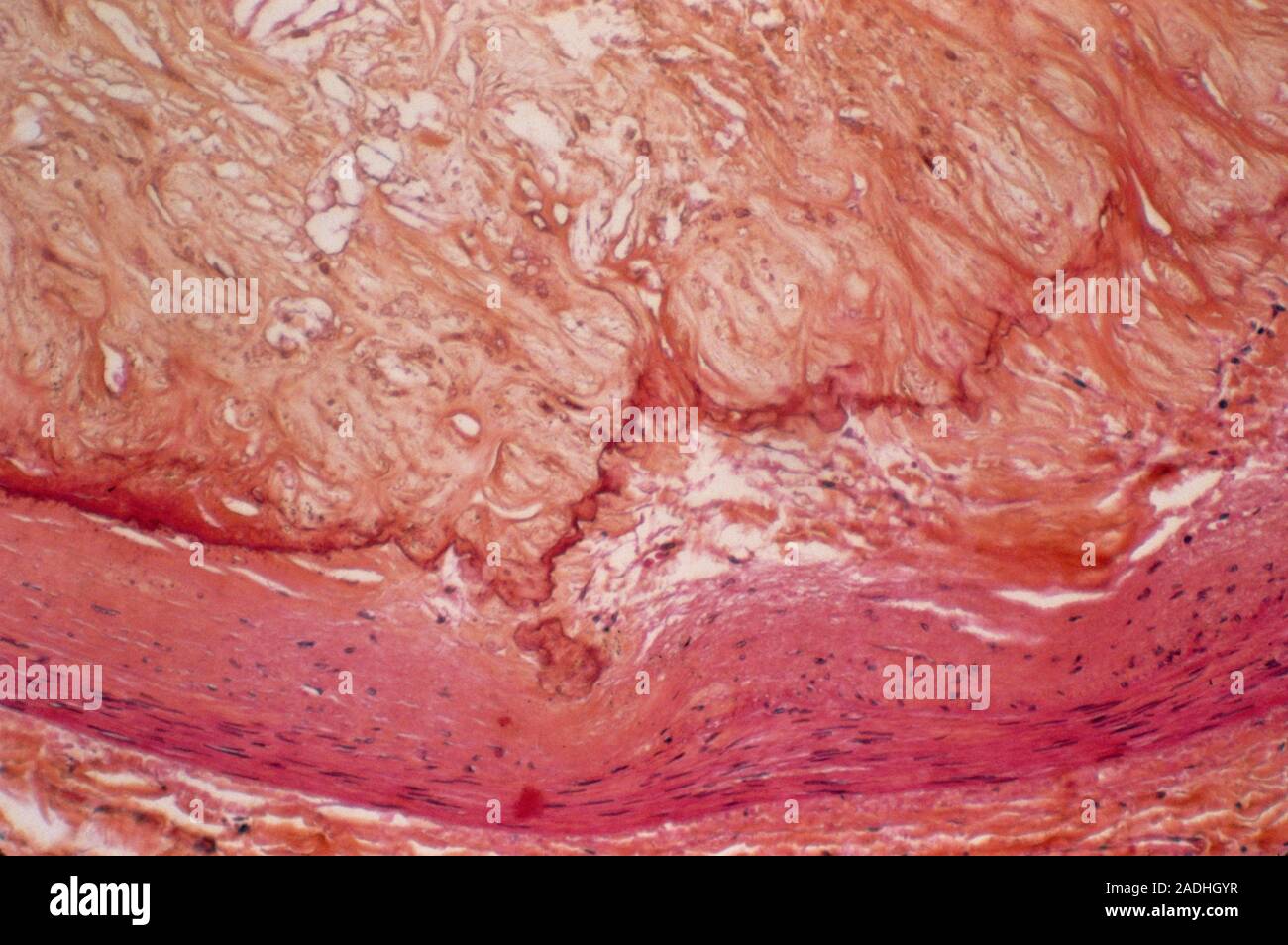 Atheroma plaque. Light micrograph of a section through an atheroma