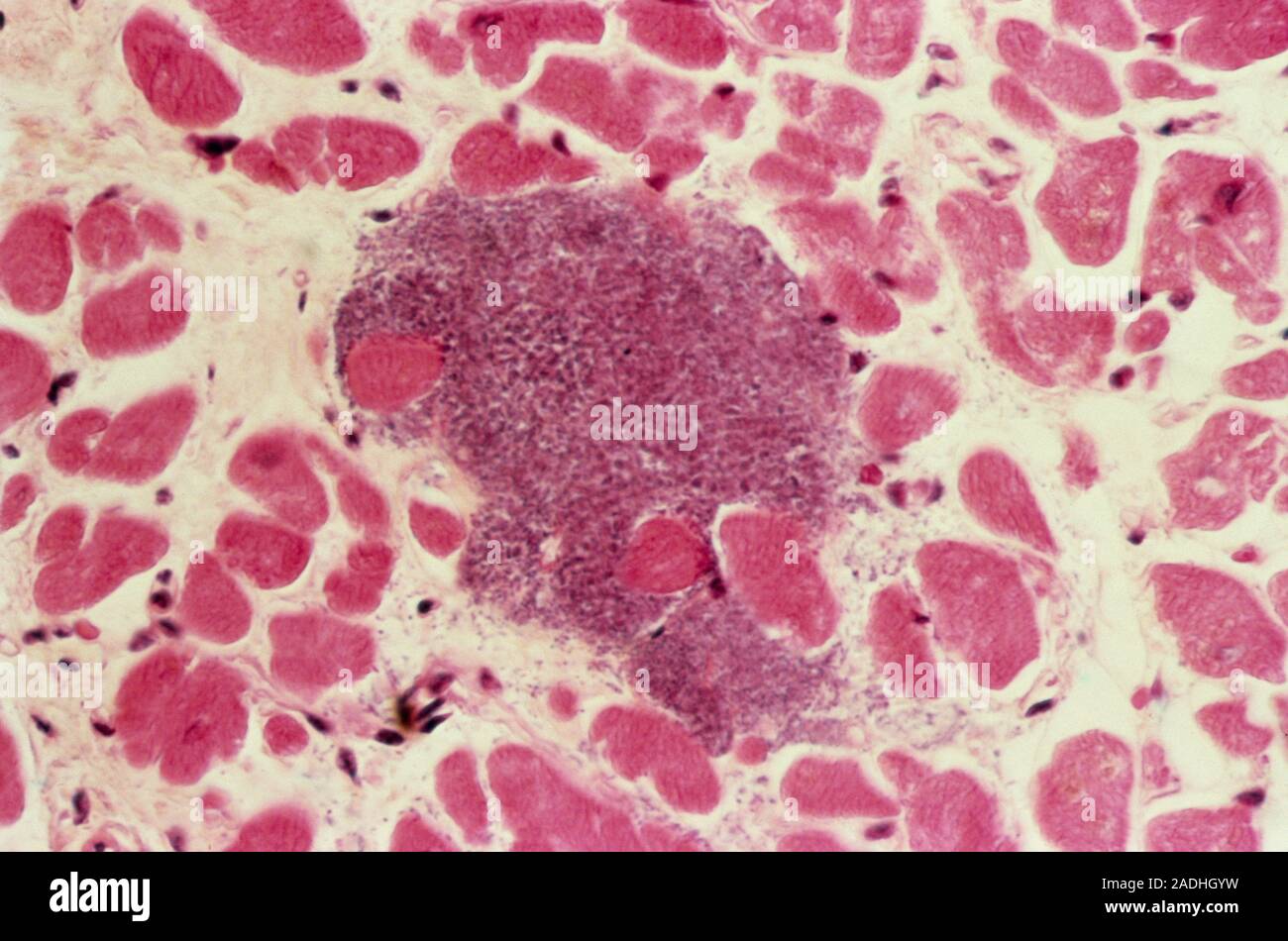 Infected inflamed heart muscle. Light micrograph of a section through