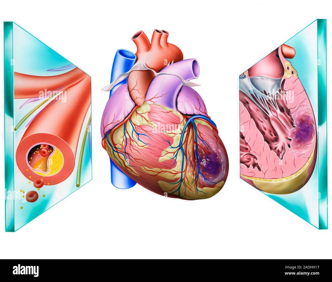 Heart attack. Artwork of a heart that has been damaged by a heart ...