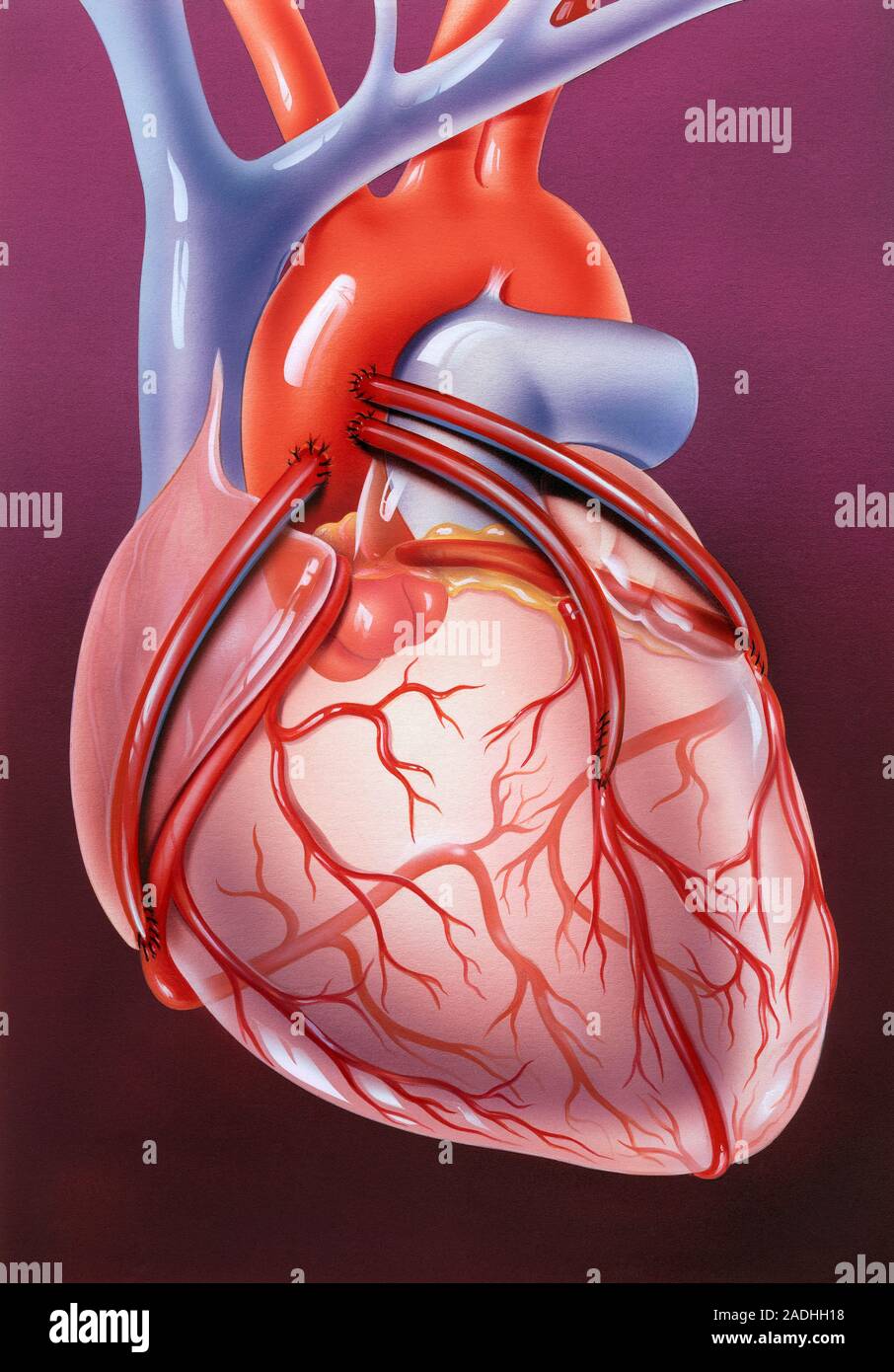 Heart bypass grafts. Artwork of a heart that has had a blockage of the coronary arteries treated