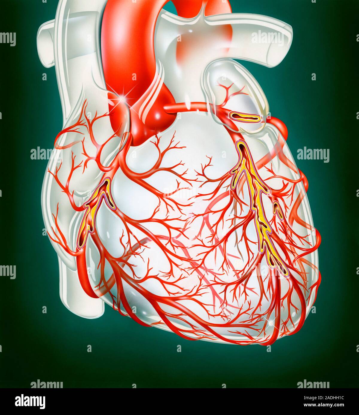 Atherosclerosis. Artwork of a human heart showing narrowing of the coronary arteries due to