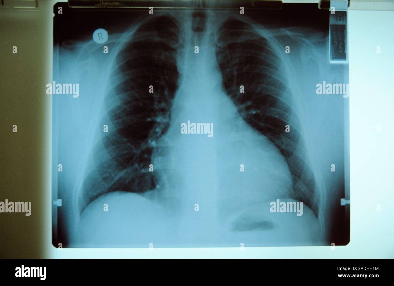 Enlarged heart. Coloured Xray showing a patient with left ventricular