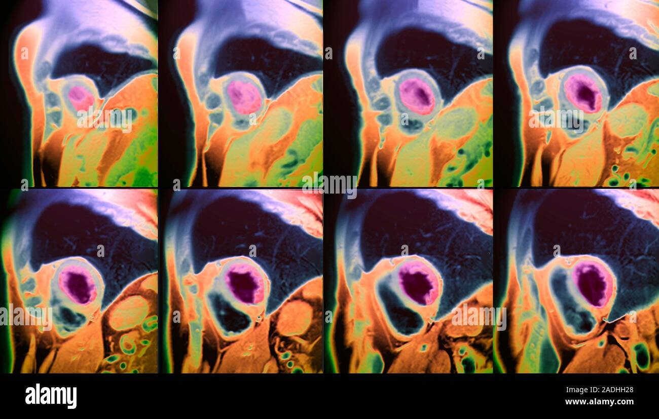 Blood clot in the heart. Sequence of coloured resonance