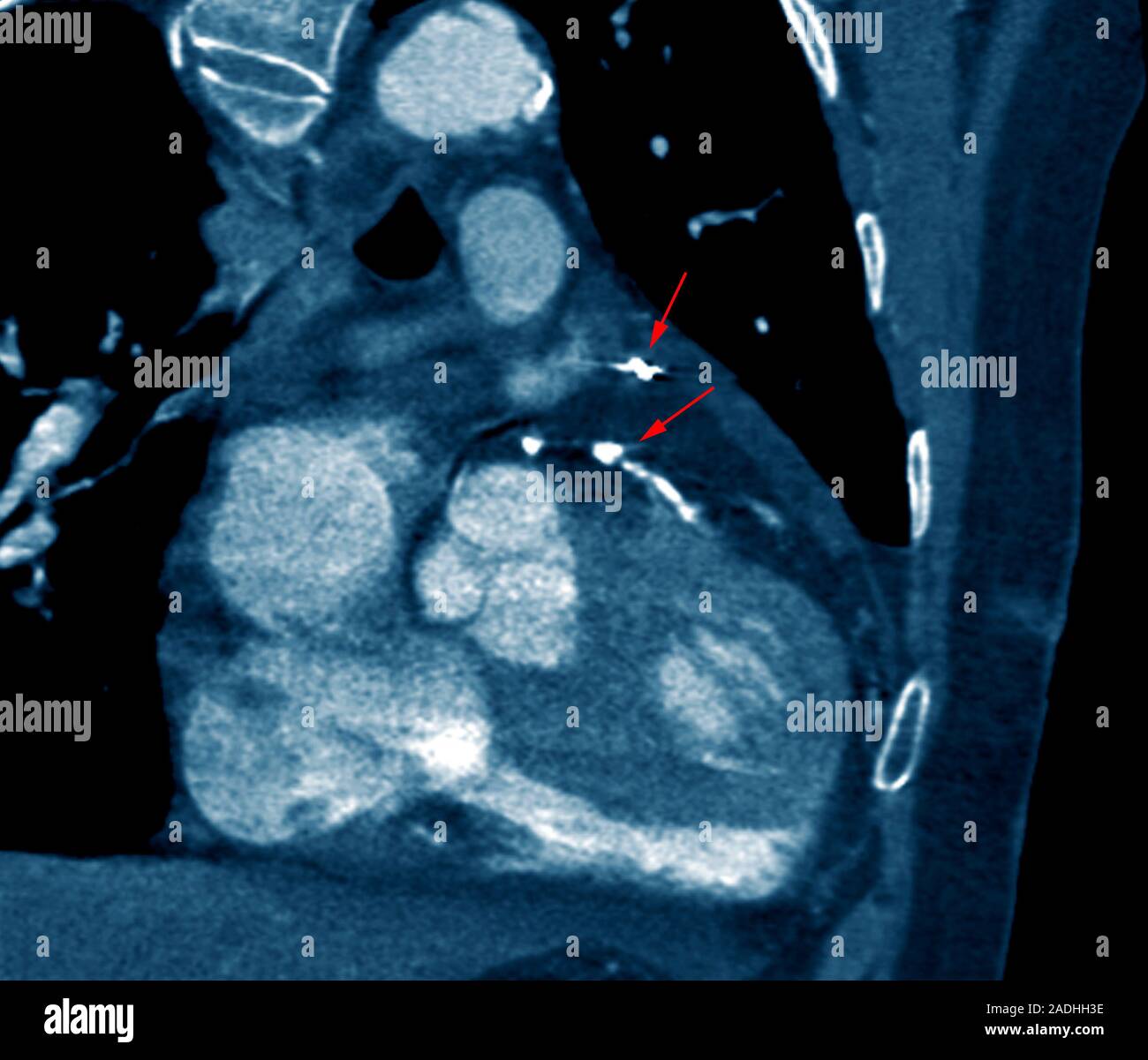 Heart bypass grafts. Coloured coronal computed tomography (CT) scan of the heart of a 72year