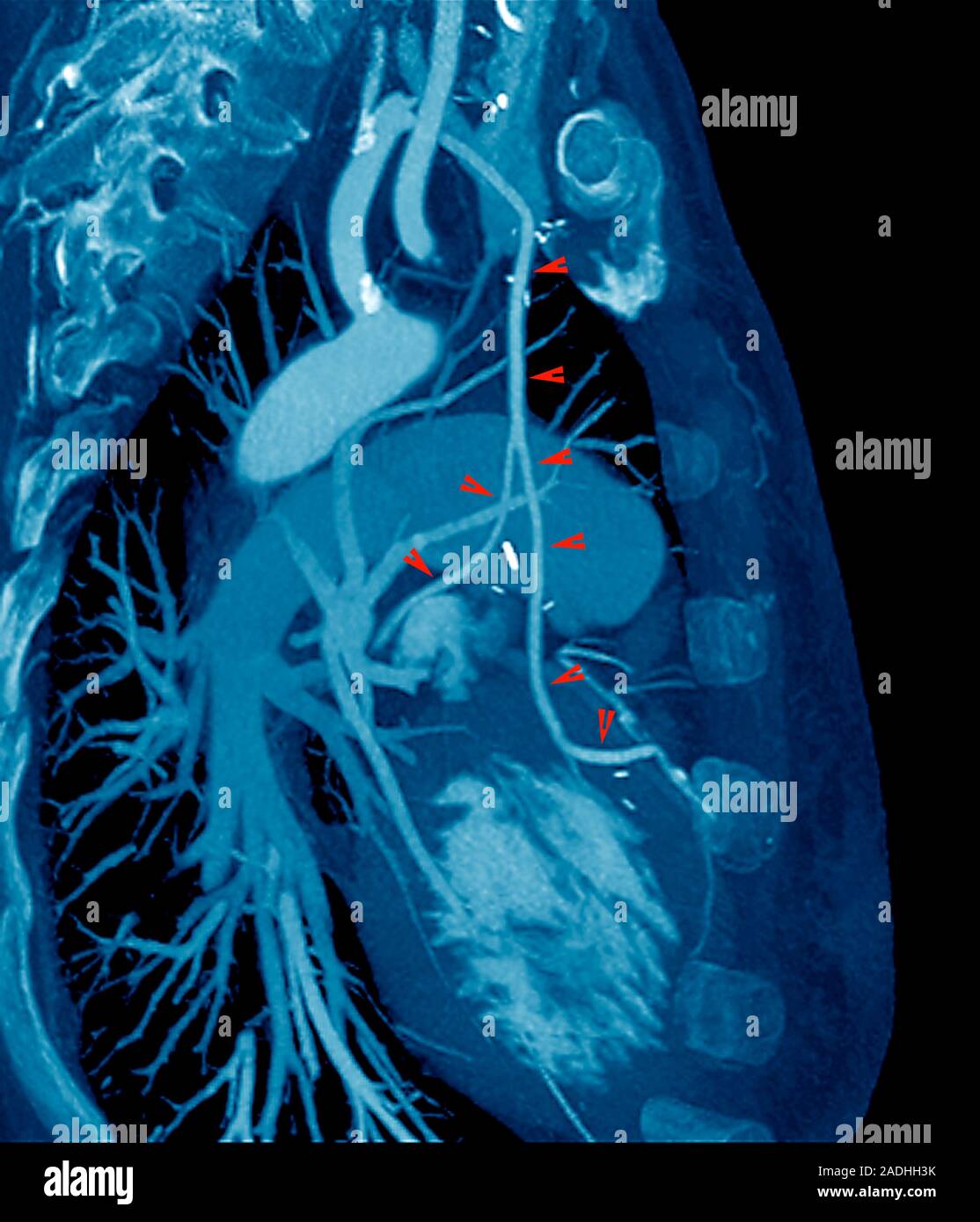 Heart bypass grafts. Coloured computed tomography (CT) scan of the chest of a 35 year old after
