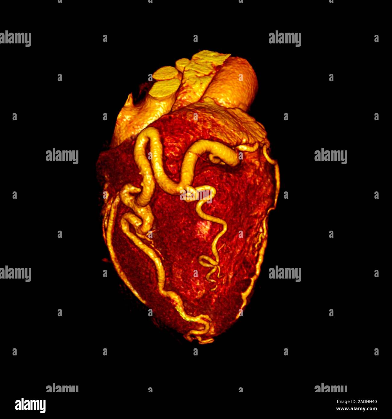 Enlarged coronary arteries. Coloured 3-D computed tomography (CT) scan