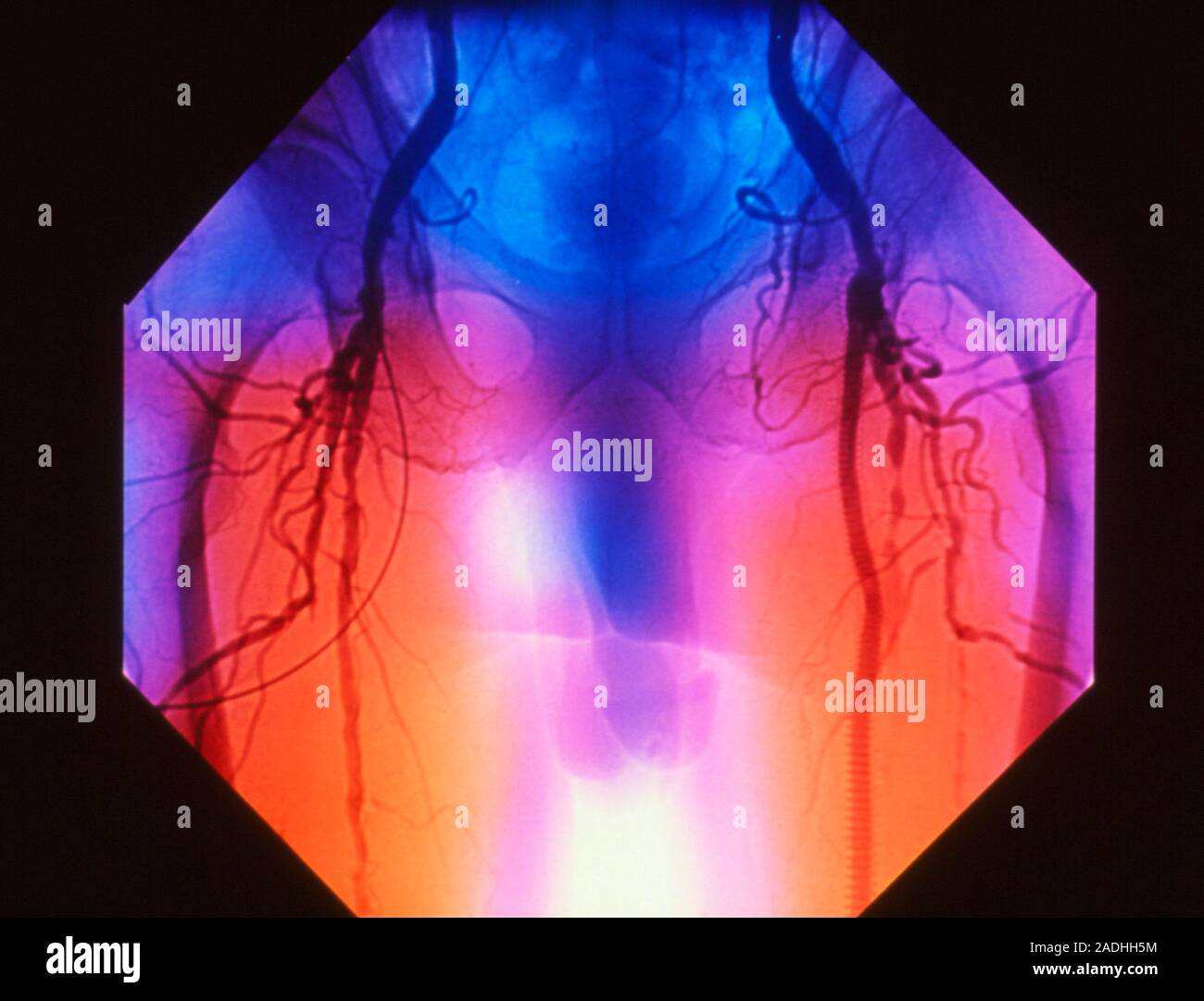 Angiogram In Leg Stent in diseased artery. False-colour angiogram of the upper legs of ...