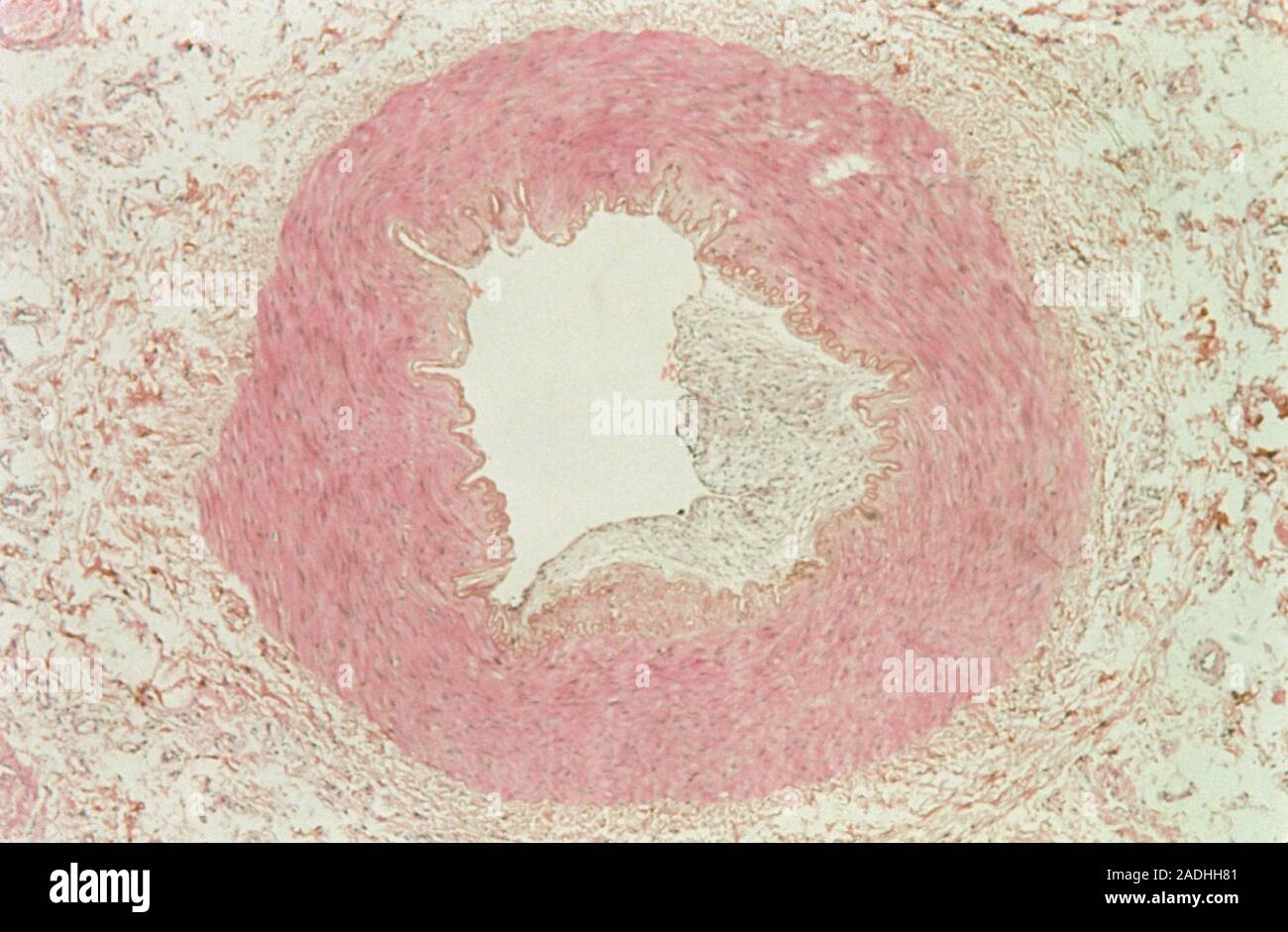 Atherosclerosis. Light micrograph of a cross section through an artery