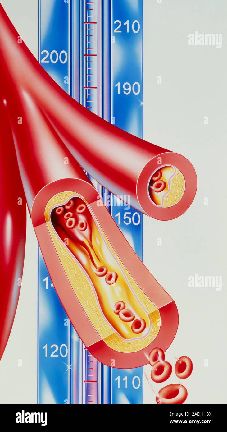 Atherosclerosis. Artwork of narrowed arteries against a blood pressure