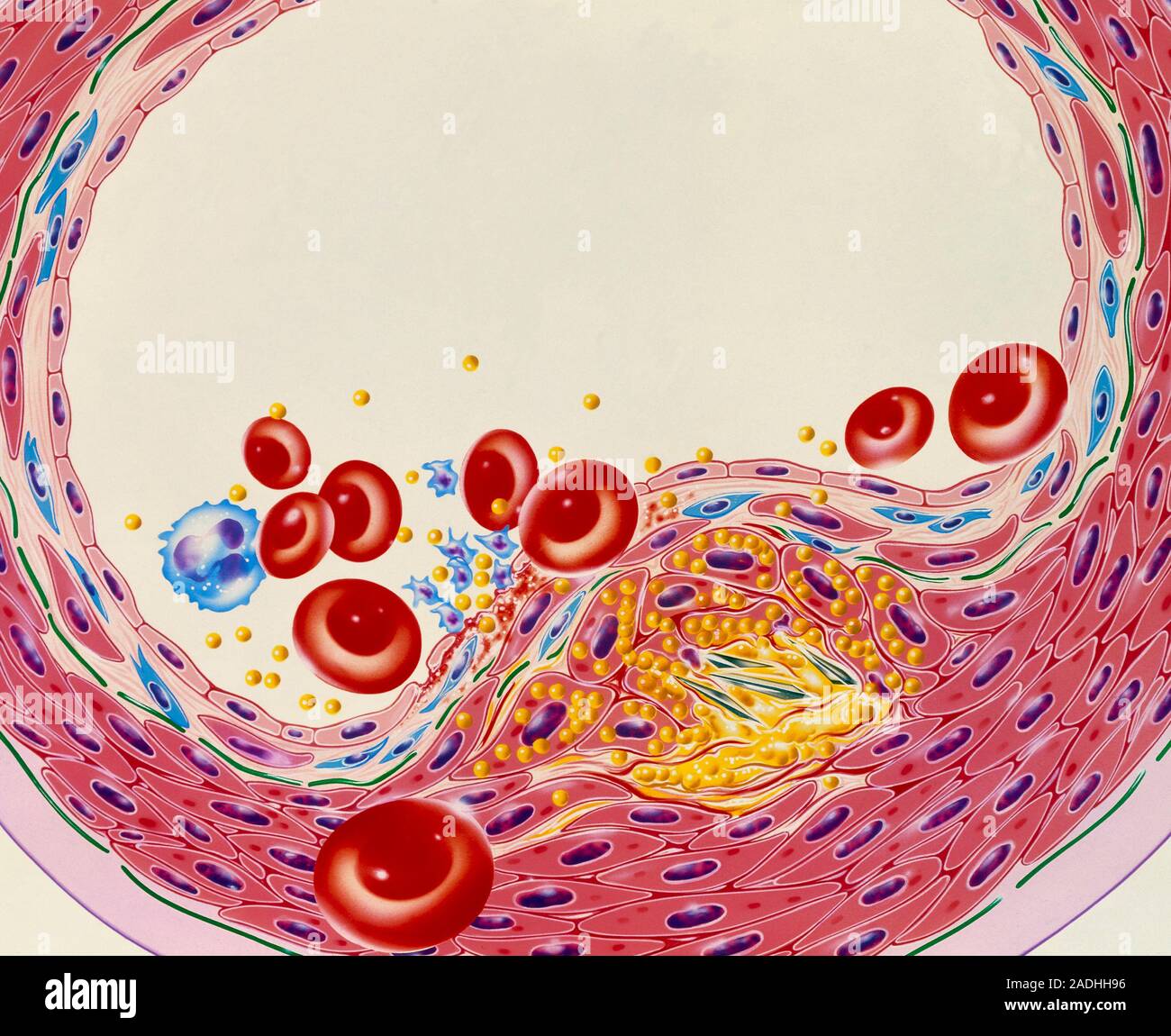 Atherosclerosis. Illustration of a crosssection through an artery