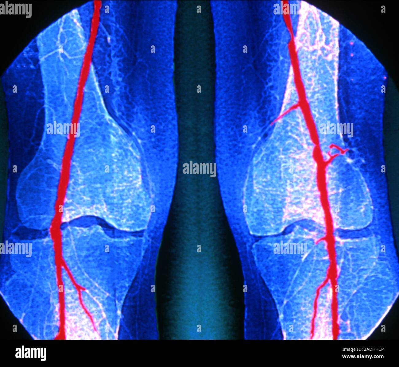 Angiogram In Leg Artery stenosis. Coloured angiogram (X-ray) of stenosis (narrowing, for ...