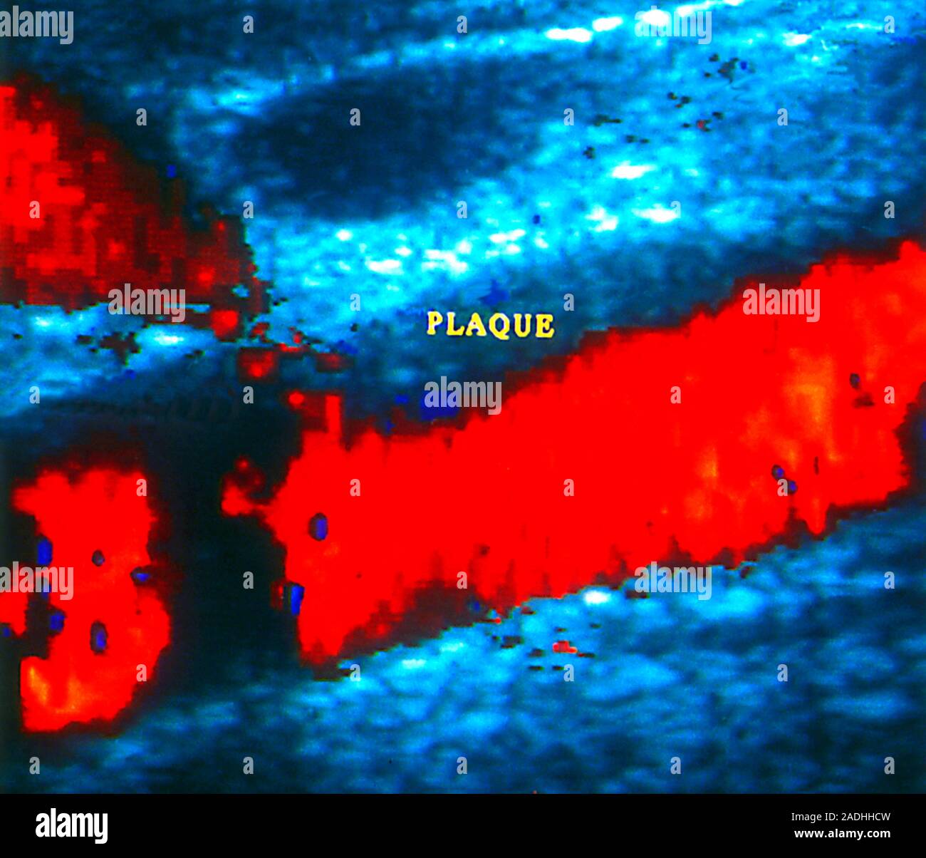 Atheroma plaque. Coloured doppler ultrasound scan of an atheroma plaque (blue) on the inner wall