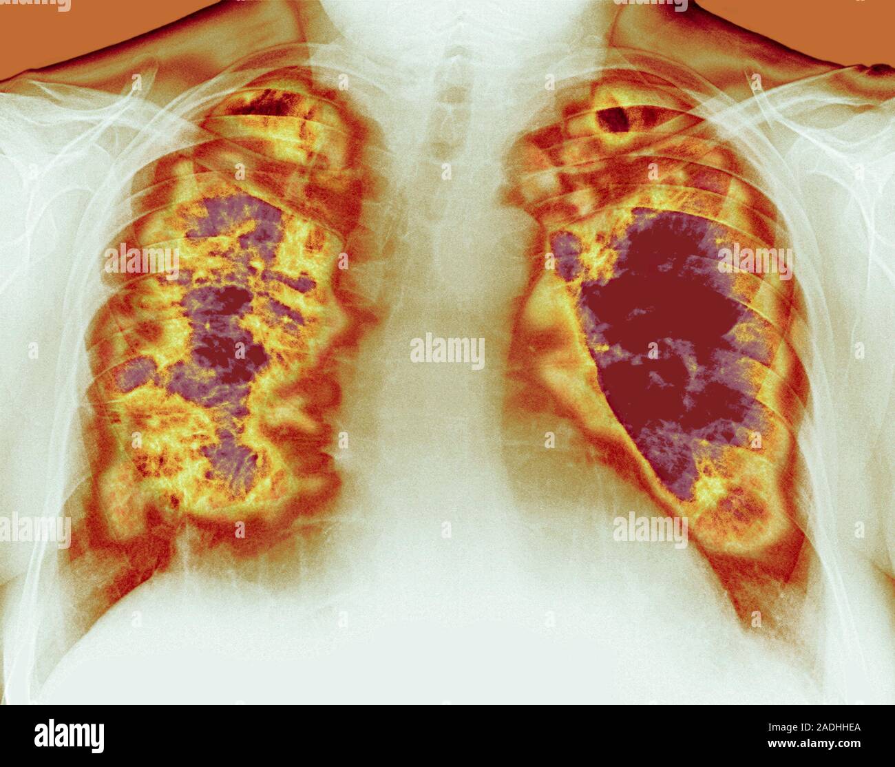 Lung cavities. Coloured chest Xray showing large cavities (dark red