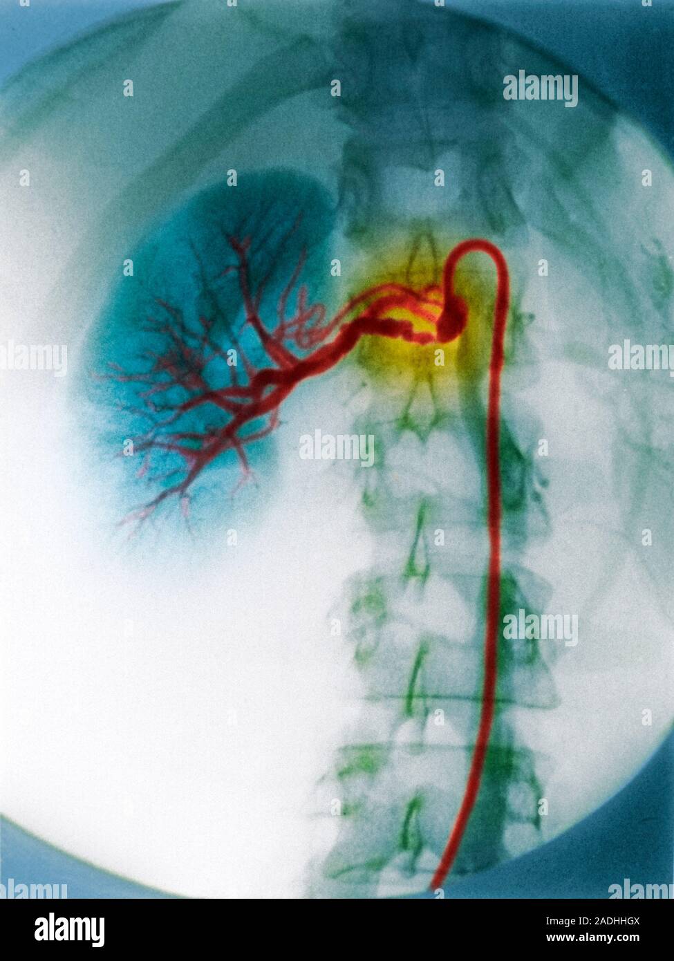 Narrowing of renal artery. Coloured Xray of the arteries (red, upper