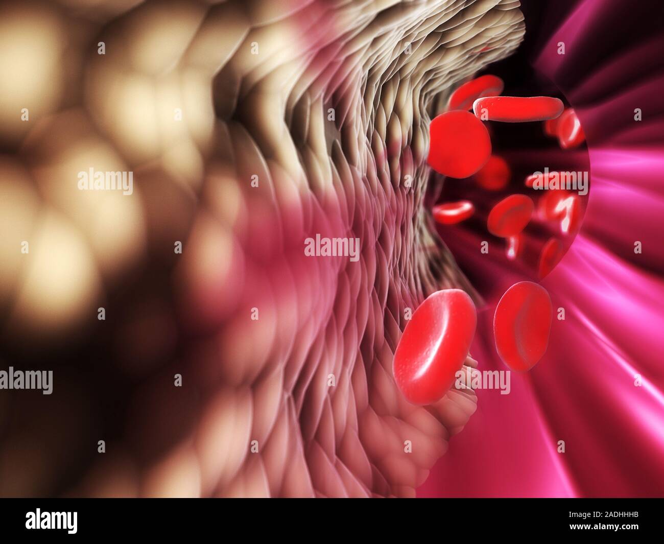 Atheroma. Computer artwork of fatty deposits (atheroma, left) building