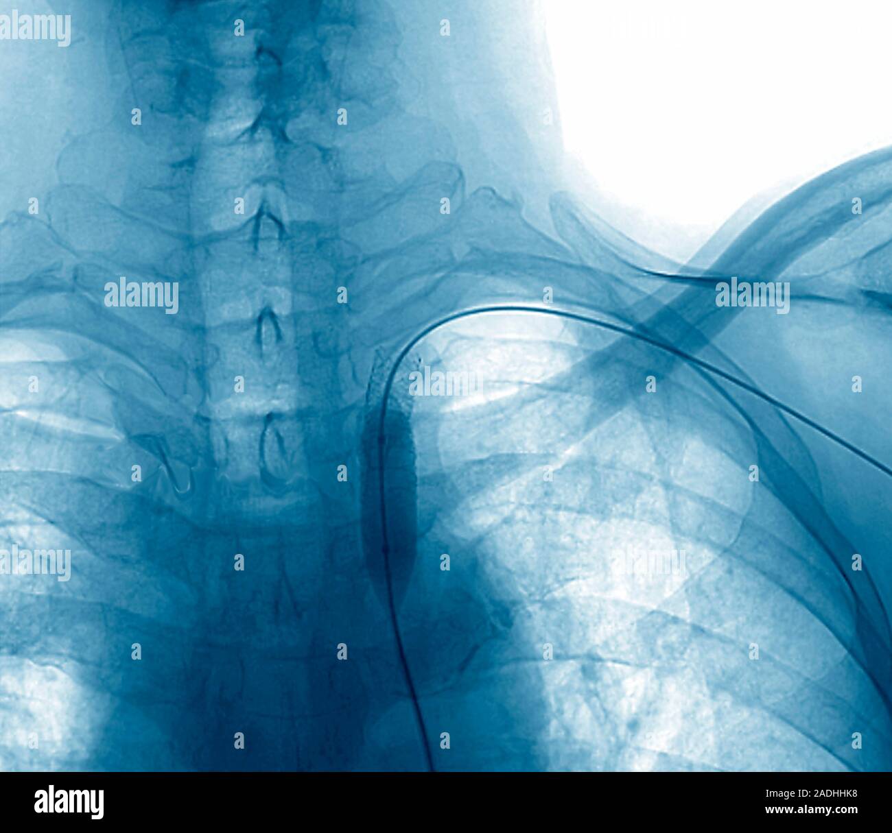Stent In Subclavian Artery Frontal Coloured Angiogram Of A Stent In stent-in-subclavian-artery-frontal-coloured-angiogram-of-a-stent-in