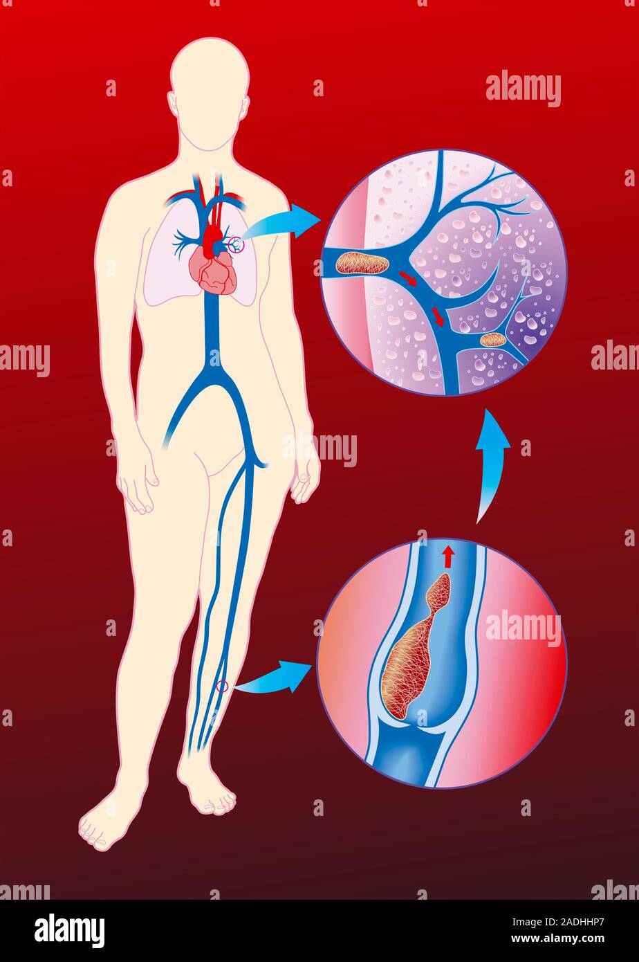 Deep vein thrombosis. Computer artwork showing blood clots in a leg