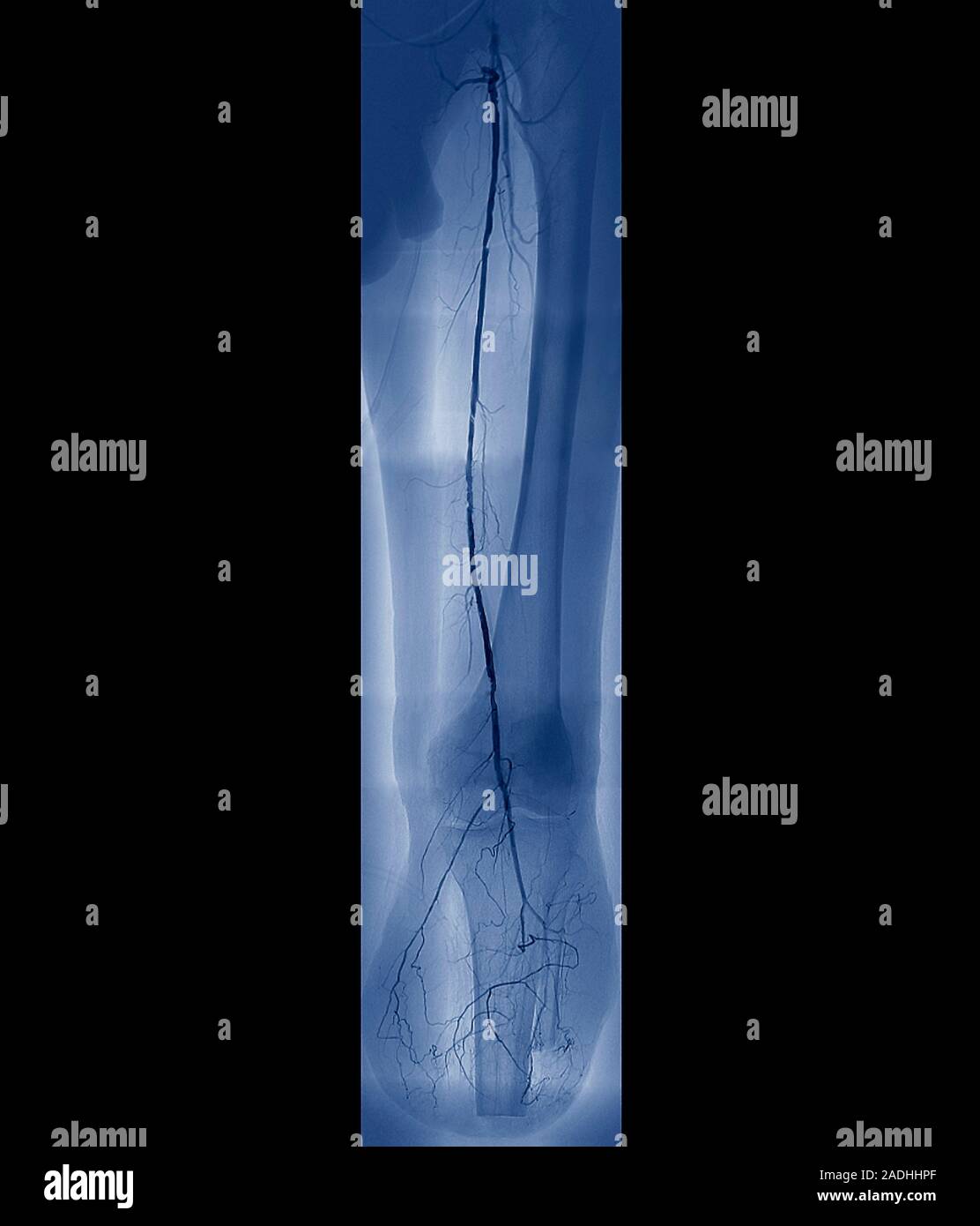Angiogram In Leg Arteritis. Coloured angiogram of the left leg of a 53 year old patient ...