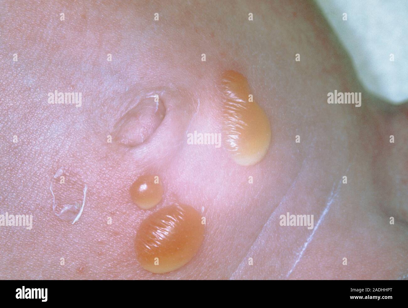 Bullous impetigo rash on an infant's abdomen. Impetigo is a bacterial ...