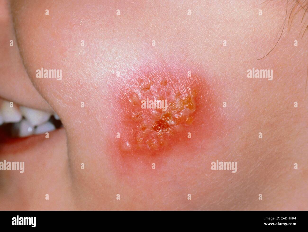 Impetigo. Closeup of an impetigo lesion on a child's cheek. Impetigo
