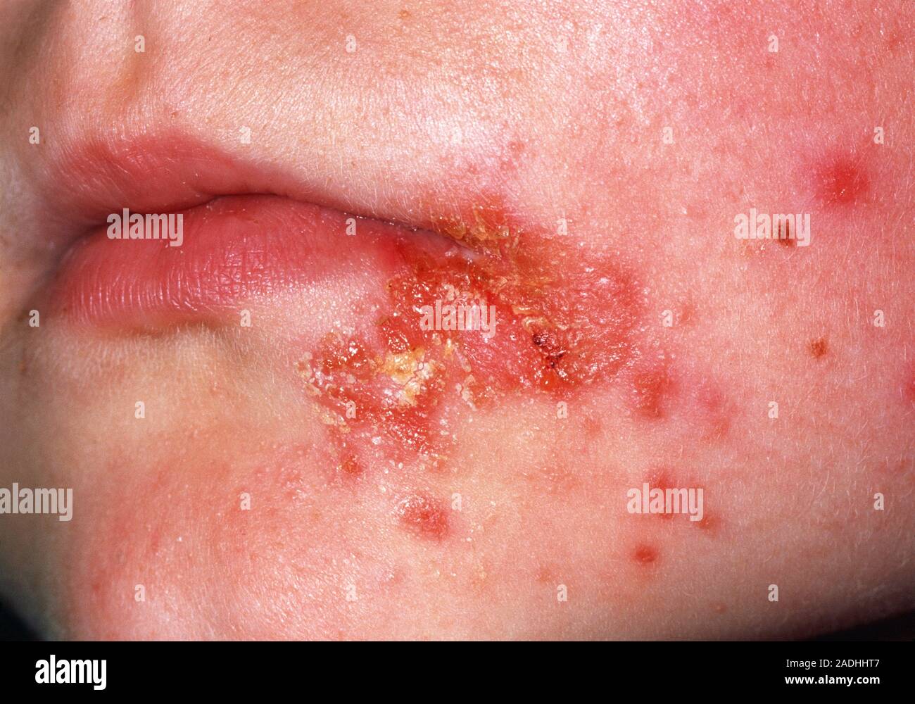 Impetigo infection around the mouth of a 7 year old girl. This is a