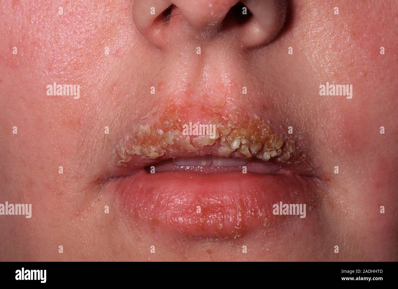 Impetigo infection on the upper lip of a 26year old woman. Impetigo