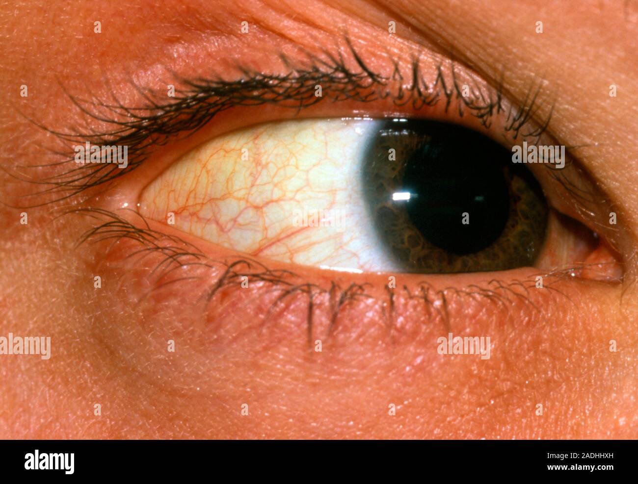 Jaundice. Yellowing of the sclera (white outer coat of eyeball) in