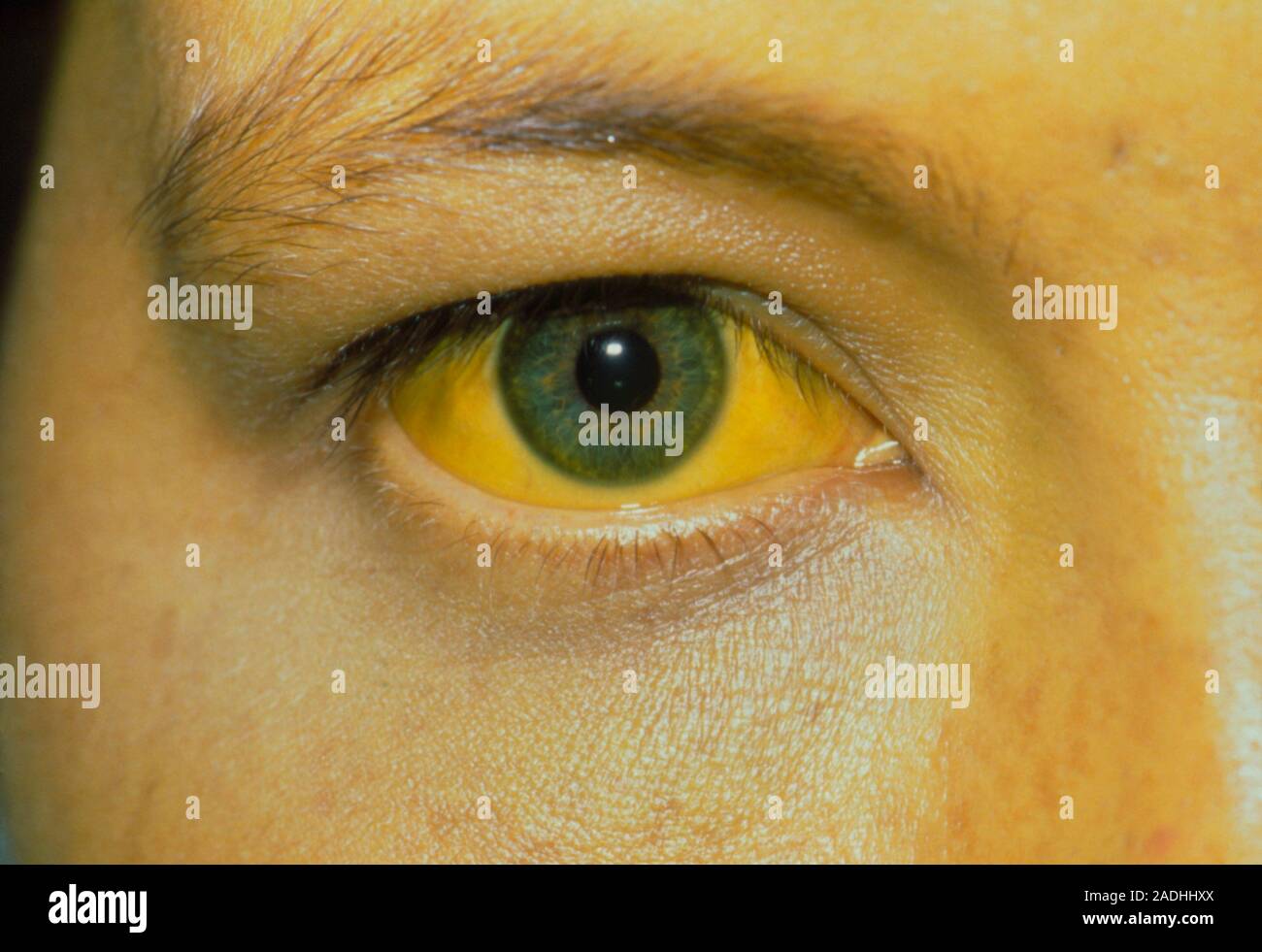 Jaundice. Closeup of the eye of a patient suffering from jaundice. Yellowing of the white