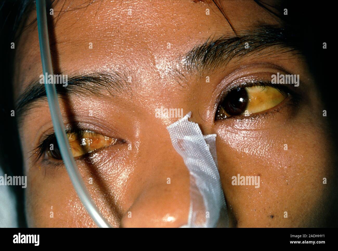 Jaundice. A patient suffering from jaundice. Yellowing of the white