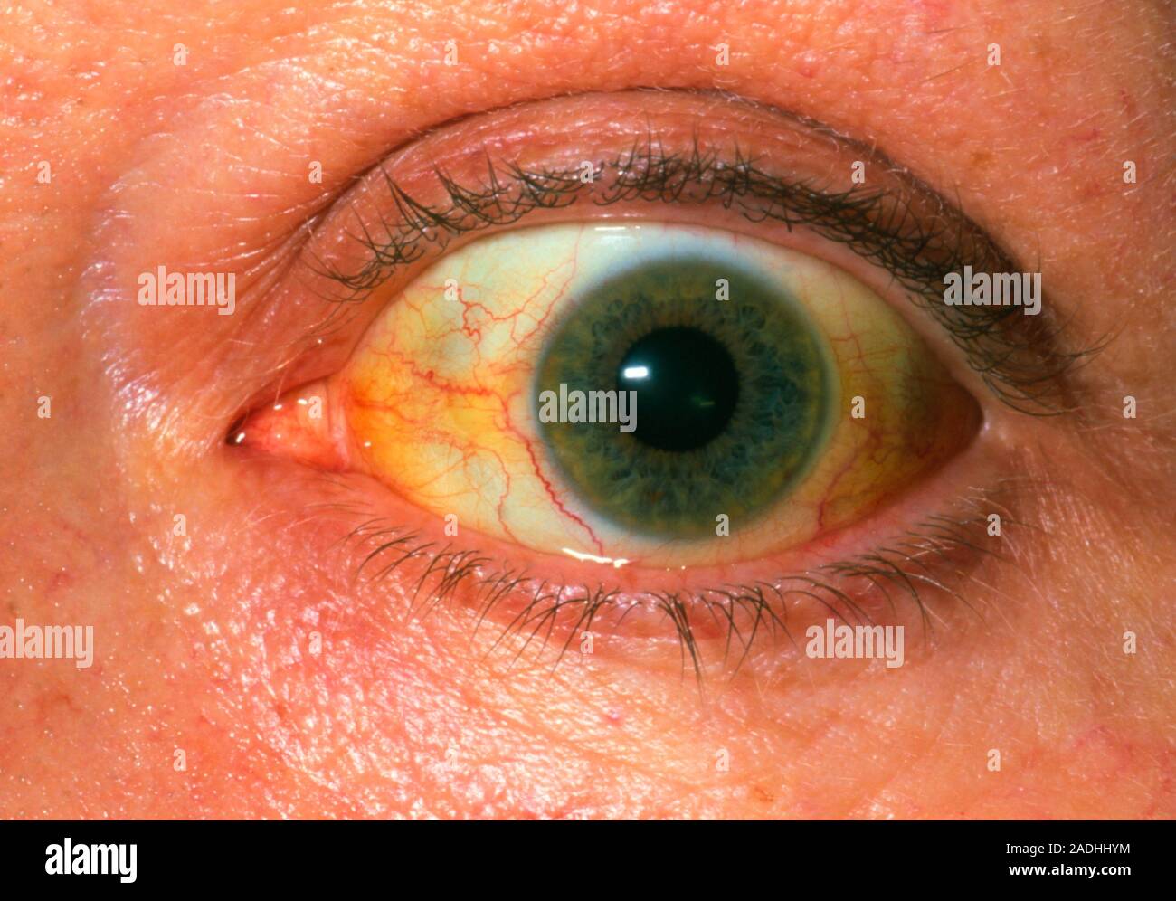 Jaundice. Closeup of the eye of a 55 year old woman showing yellowing caused by jaundice