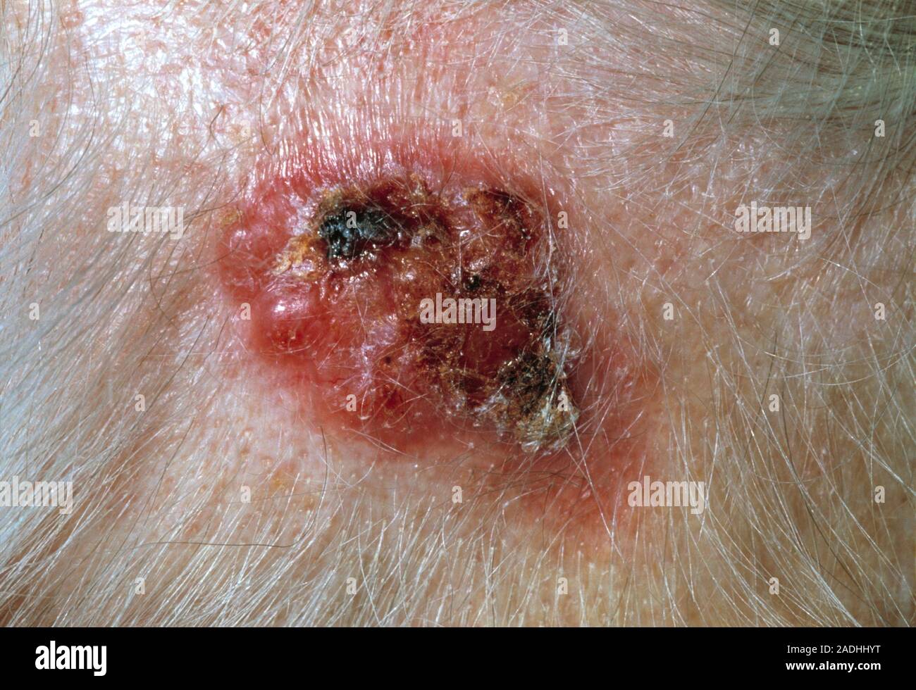 Seborrhoeic wart, or keratosis, on the temple of a 90 year old woman