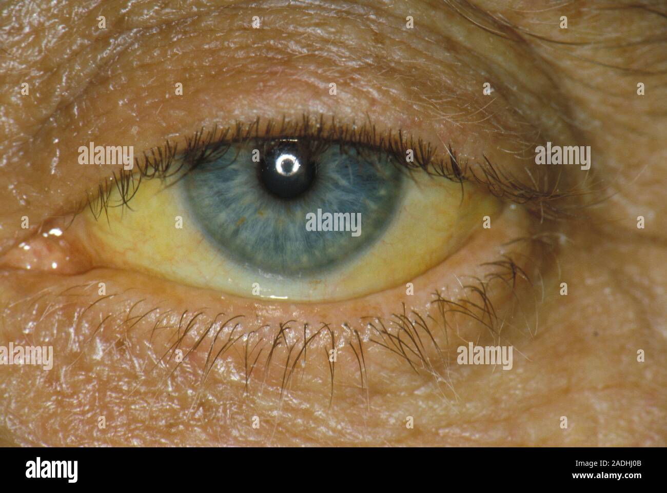 Jaundiced eye in a case of obstructive jaundice. This is where the bile