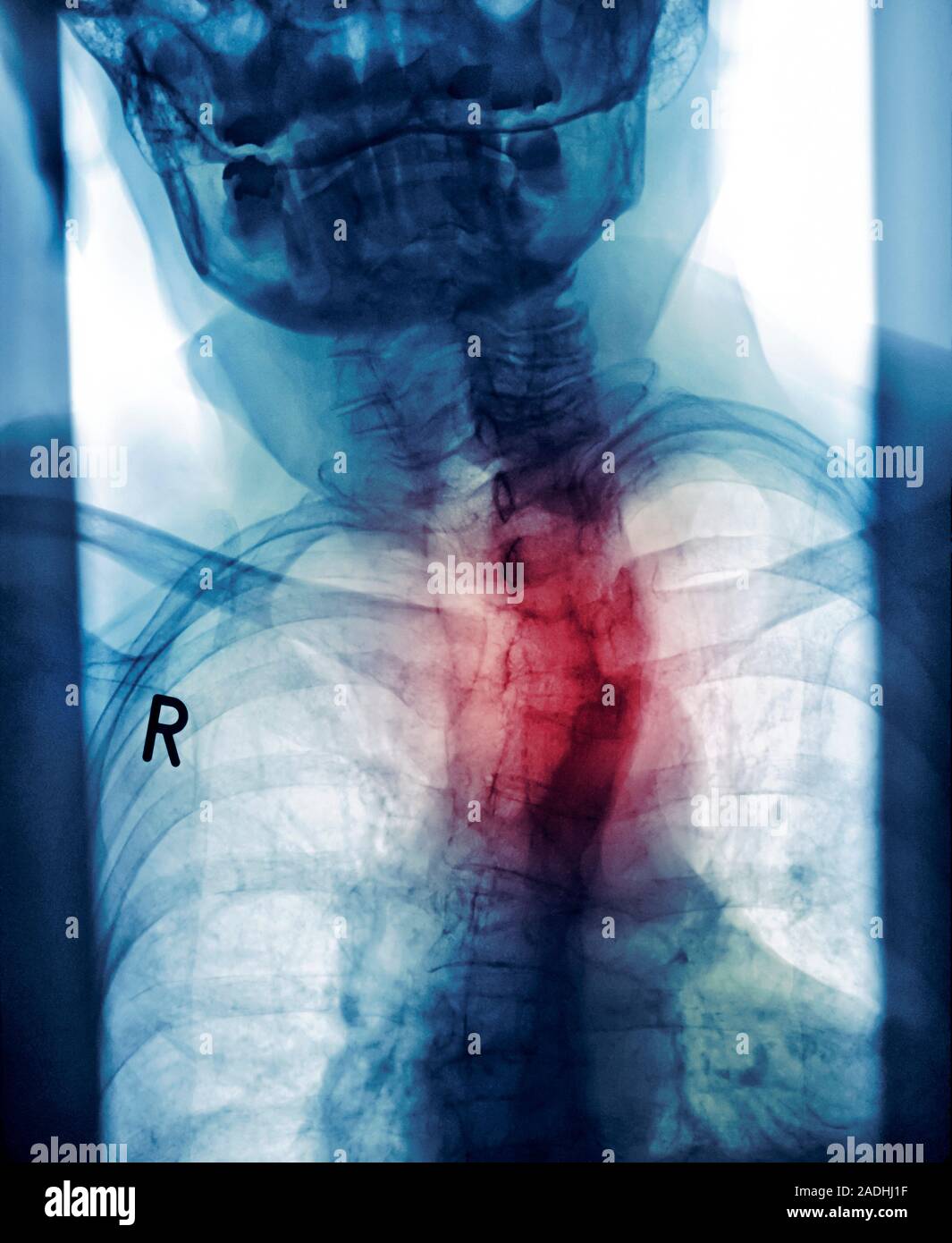 Curved spine. Coloured frontal Xray of a female patient with kyphosis