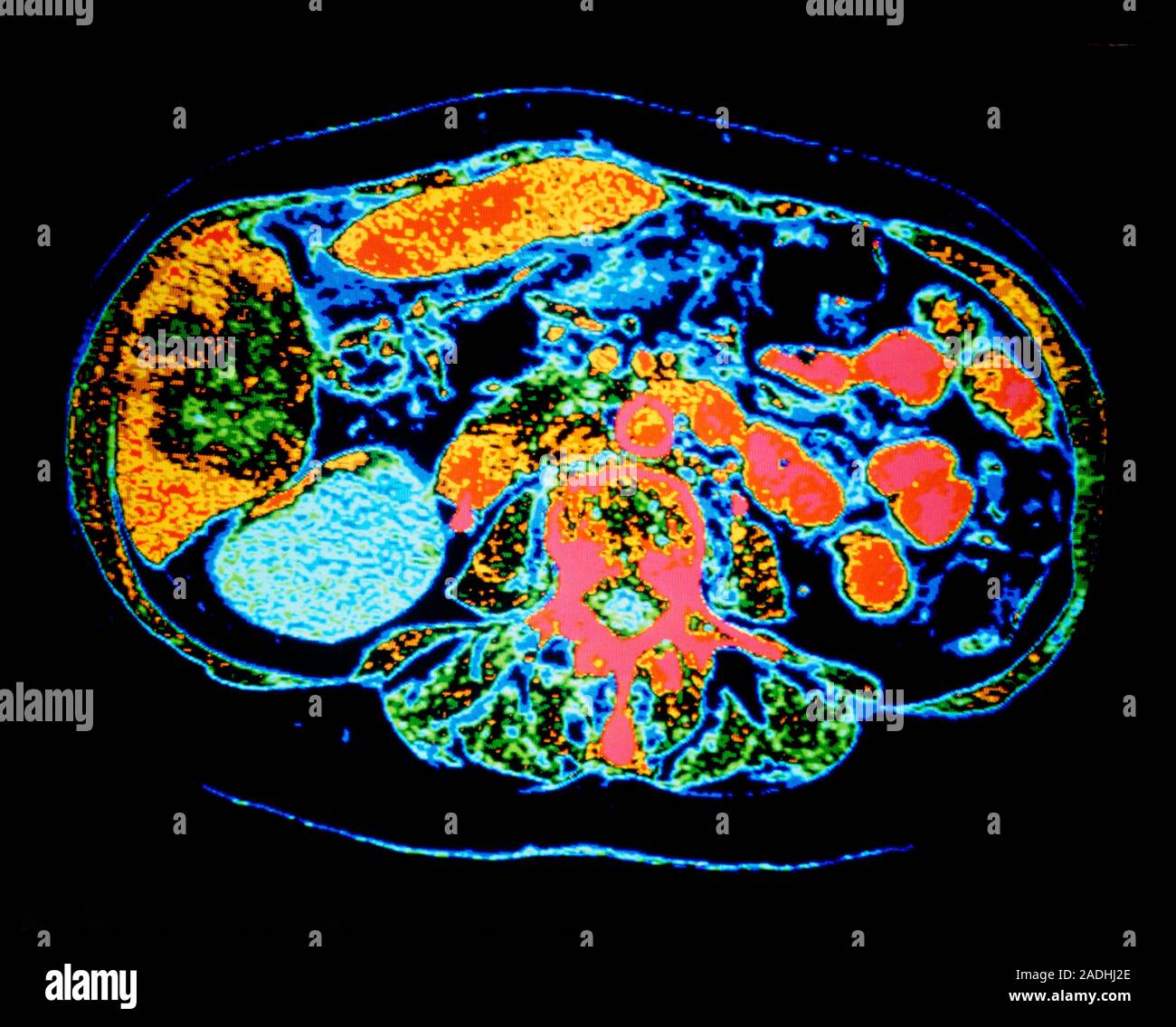 Kidney cyst. Falsecolour computed tomography (CT) scan of an axial