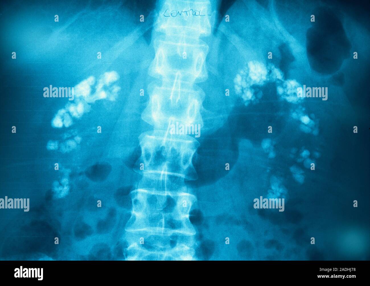 Kidney calcification. Xray of the abdomen of a patient with