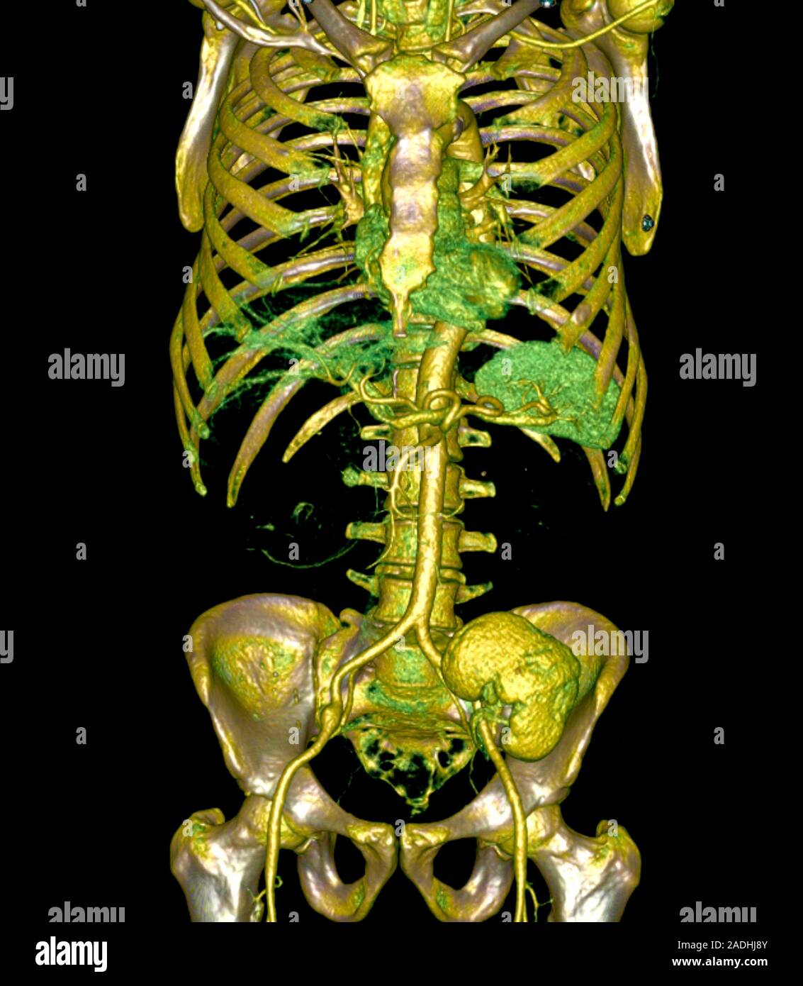 Transplanted kidney. Coloured 3D computed tomography (CT) scan of the