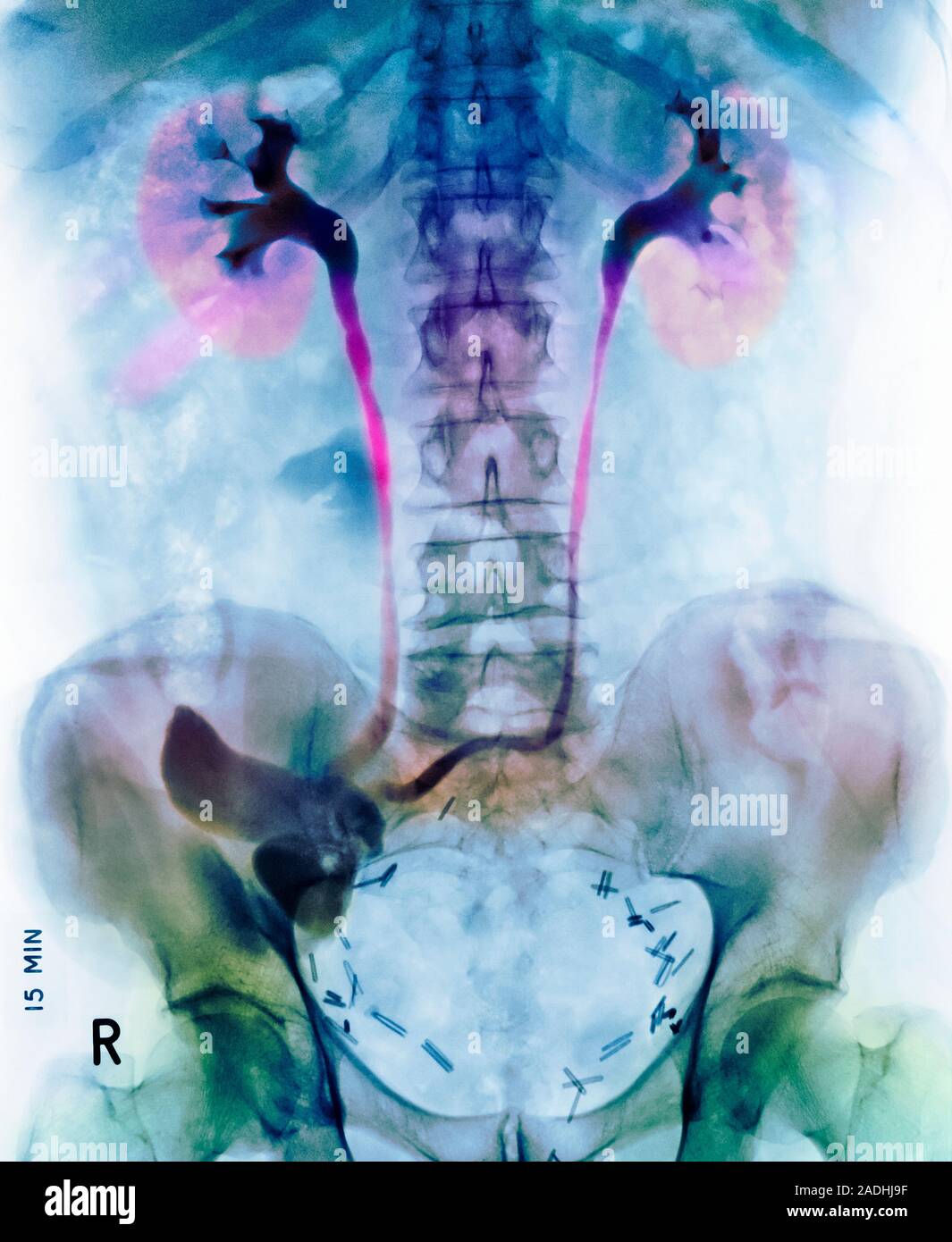 Ileal conduit surgery. Coloured frontal Xray of a male patient shortly after having an ileal